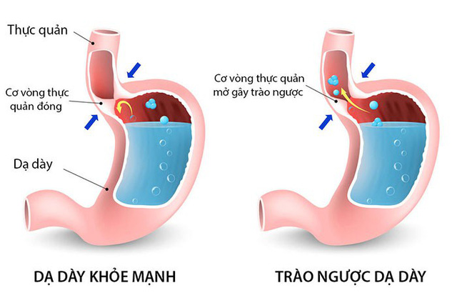 Gastroesophageal Reflux Disease - Hình ảnh minh họa